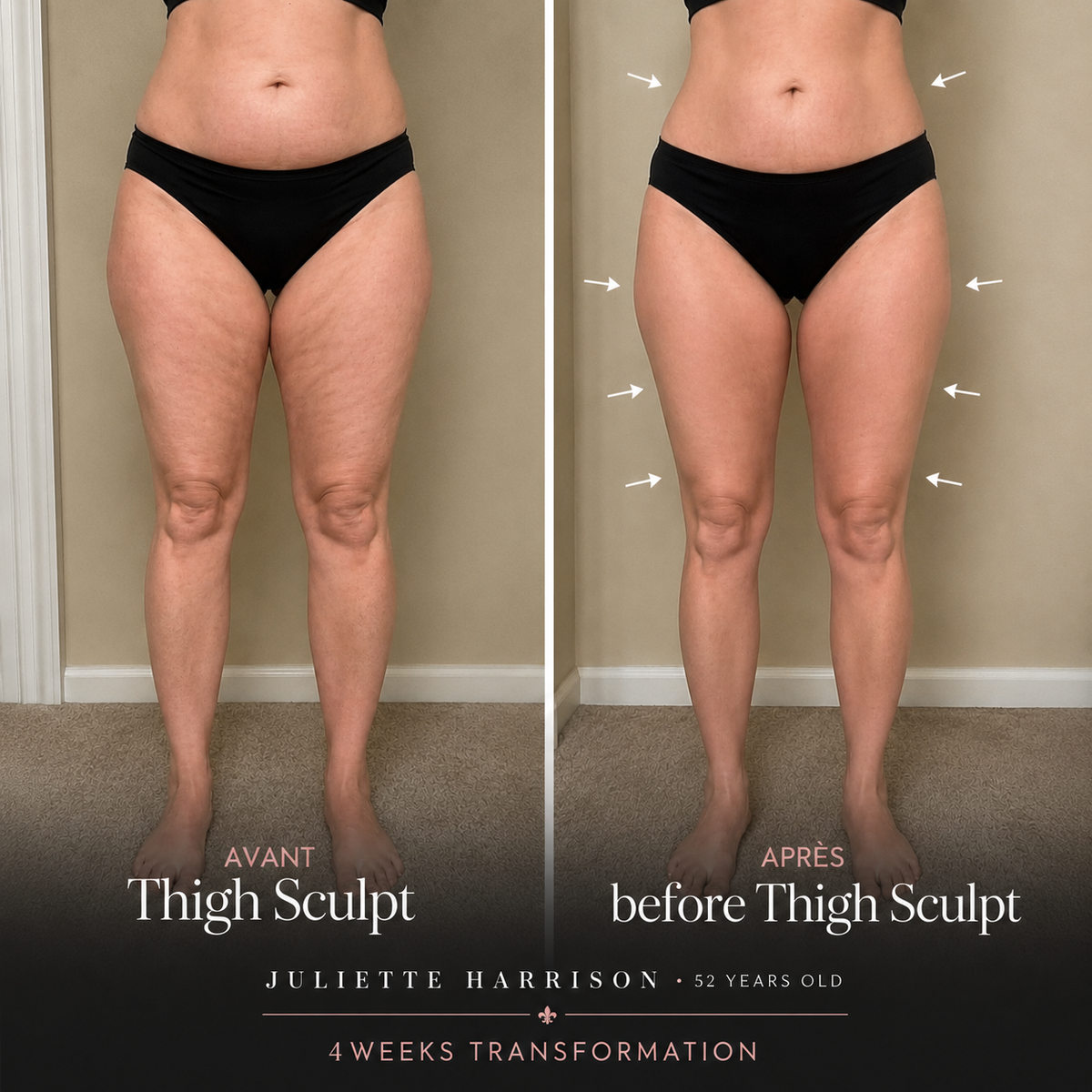 Thigh Sculpt before and after
