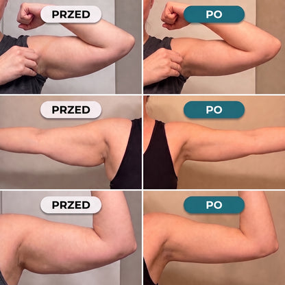 Armelle® Opaski na Ramiona