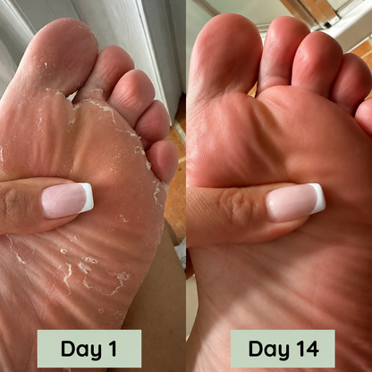 Luvantia - DermaPure® Anti-Fungal Soap